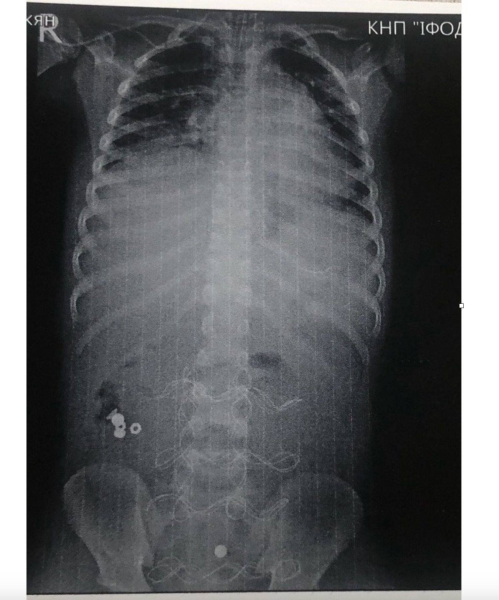 Дитина з Прикарпаття проковтнула батарейку, яка зруйнувала кишечник: що зараз із хлопчиком (ФОТО)